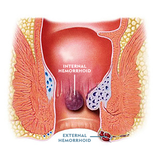 Diagram of Internal Hemorrhoid