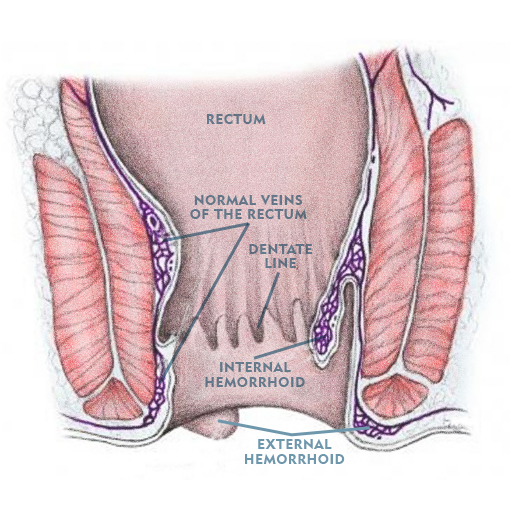 Diagram of External Hemorrhoid